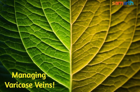 Varicose Veins